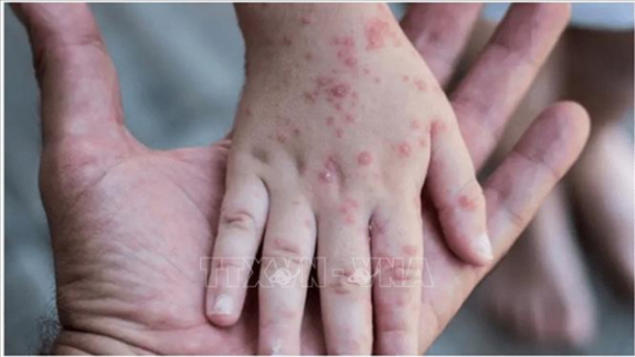 Đức ghi nhận ca mắc bệnh đậu mùa khỉ đầu tiên ở trẻ em